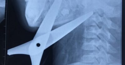 Cứu sống bé trai 7 tuổi bị kéo đâm xuyên cổ